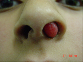 nasal polyps cough
