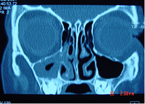 CT scan of sinuses