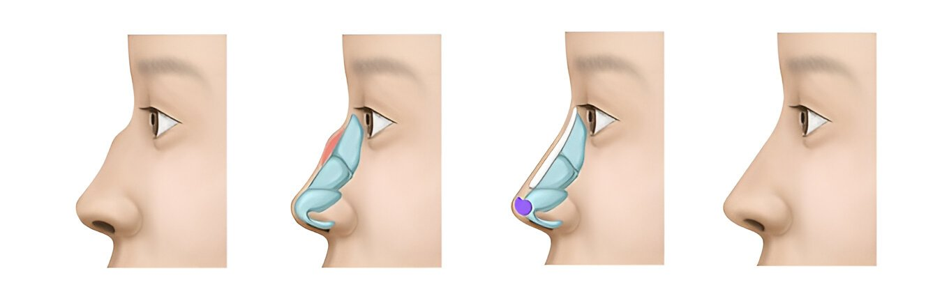 Rhinoplasty - Nose correction surgery - Dr Murali Mahadevan - ENT